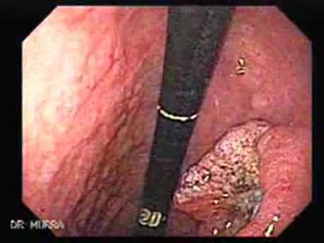 Rak gruczołowy trzonu żołądka (2 z 6)