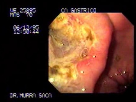Wrzodziejący gruczolakorak trzonu żołądka - endoskopia 2