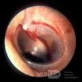 Uraz ciśnieniowy  z krwawieniem do ucha środkowego