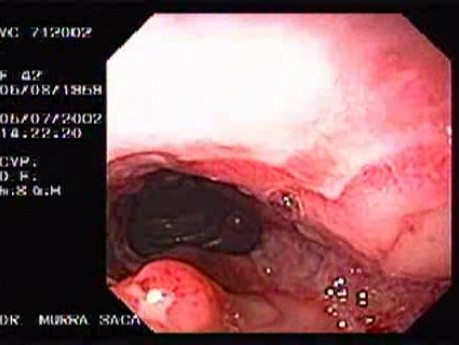 Choroba Leśniowskiego - Crohna - endoskopia (12 z 28)