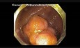 Komplikacje mukozektomii endoskopowej (EMR) - krwawienie z kątnicy - klip A