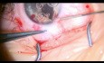 Plastyka - "zamknięcie" częściowego, wrodzonego ubytku tęczówki (kolobomy) oraz utworzenie okrągłej źrenicy, wykonane u 5cio letniej pacjentki