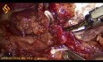 Laparoskopowe wycięcie węzłów chłonnych okolicy nadtrzustkowej z powodu raka żołądka