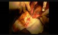 Utworzenie zespolenia typu Y-graft z użyciem obu tętnic piersiowych wewnętrznych w zabiegu pomostowania aortalno-wieńcowego 