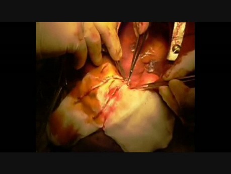Utworzenie zespolenia typu Y-graft z użyciem obu tętnic piersiowych wewnętrznych w zabiegu pomostowania aortalno-wieńcowego 