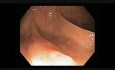 Kolonoskopia: ząbkowany gruczolak z rakiem śródśluzówkowym