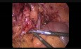 Laparoskopowa resekcja esicy z powodu choroby uchyłkowej powikłana przetoką okrężniczo-pochwową