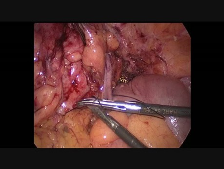 Laparoskopowa resekcja esicy z powodu choroby uchyłkowej powikłana przetoką okrężniczo-pochwową