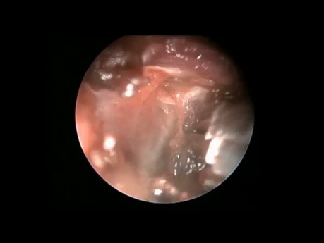 Endoskopowe usunięcie naczyniaka jamistego dołu podskroniowego z dojścia przez nasoantrostomię dolną