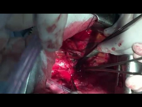 Ostre rozerwanie oskrzela głównego lewego po pneumonektomii