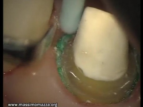 Ostateczna preparacja zębów 11 - 15 pod uzupełnienie protetyczne (2/3)