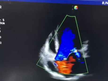 13. Przypadek kardiologiczny - Co widzisz w echokardiografii?