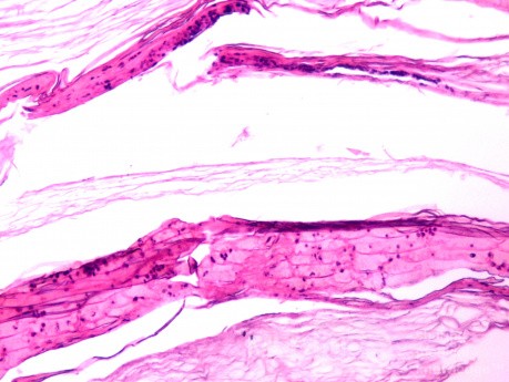 Histologia strupa (odlewu) z błony bębenkowej