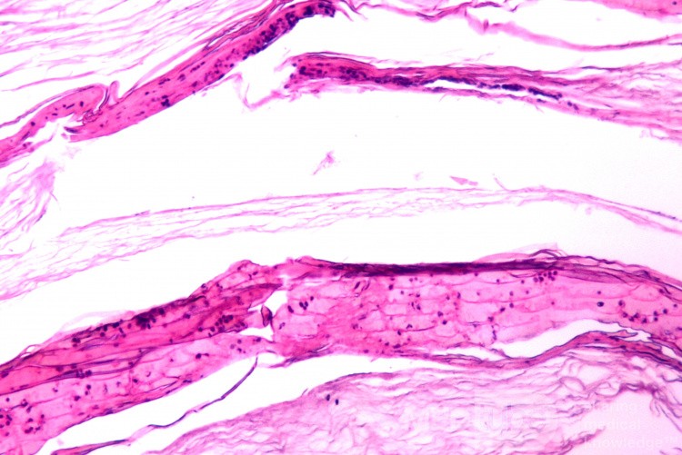 Histologia strupa (odlewu) z błony bębenkowej