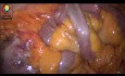 Recherche de Diverticulite de Meckel