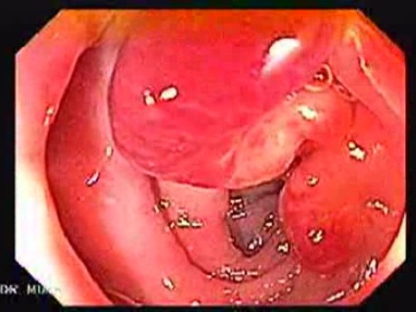 Obraz endoskopowy zapalenia uchyłków esicy (1 z 4)