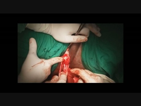 Leczenie wypadania pochwy metodą podwieszania do więzadła krzyżowo-kolcowego