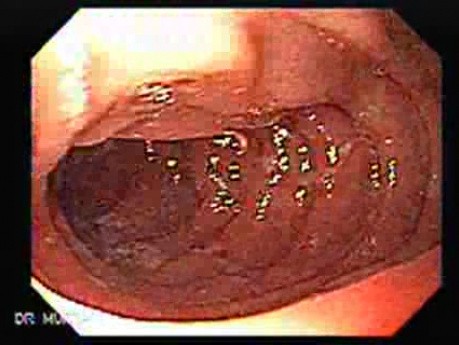 Liczne nadżerki dwunastnicy spowodowane Salmonellą Enteritis (4 z 5)