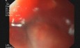 Gastroscopy in a Patient with Boerhaave Syndrome