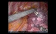 S1-S3 tri-segmentektomia górnego płata lewego płuca