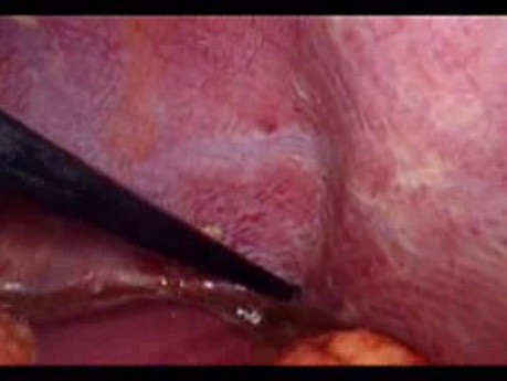 Perforacja okrężnicy z zapaleniem otrzewnej - laparoskopia (36 z 46)