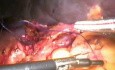 Splenektomia - metoda laparoskopowa