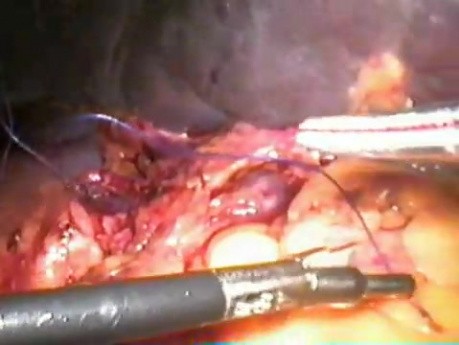 Splenektomia - metoda laparoskopowa