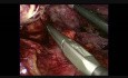 Splenektomia laparoskopowa z ręczną asystą połączona z resekcją wielonarządową