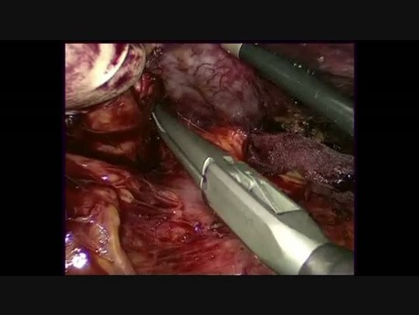 Splenektomia laparoskopowa z ręczną asystą połączona z resekcją wielonarządową