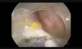 ESD uszypułowanego polipa esicy - sposób na duże naczynia w szypule