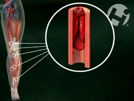 Zablokowany przepływ krwi do lewej nogi