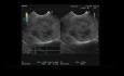 Endoskopowe USG pseudobrodawkowego guza trzustki